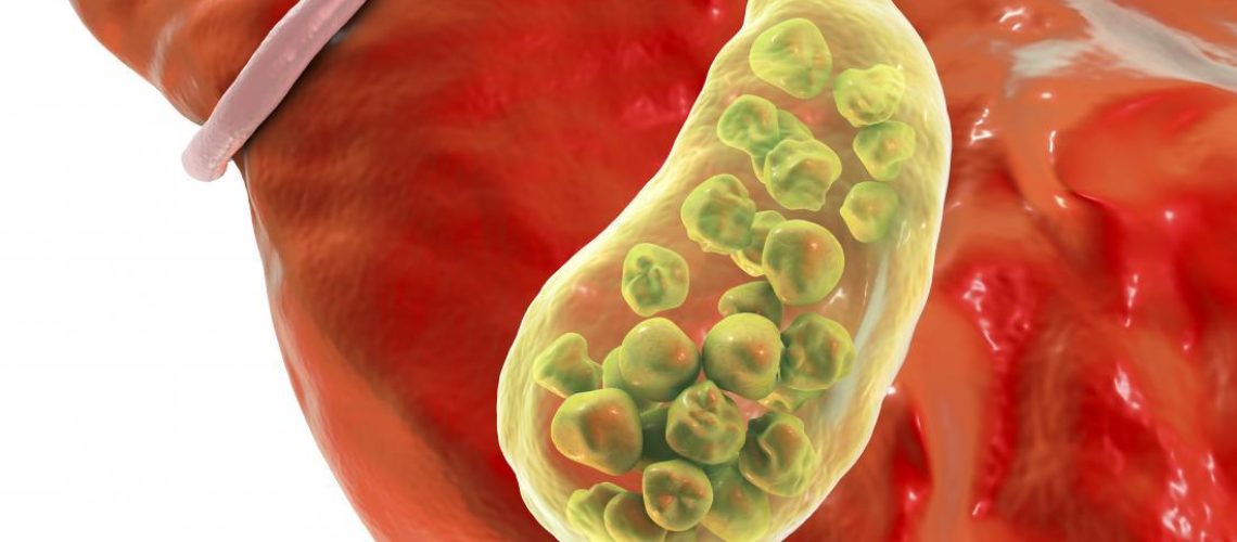 دکتر التهاب کیسه صفرا در اصفهان