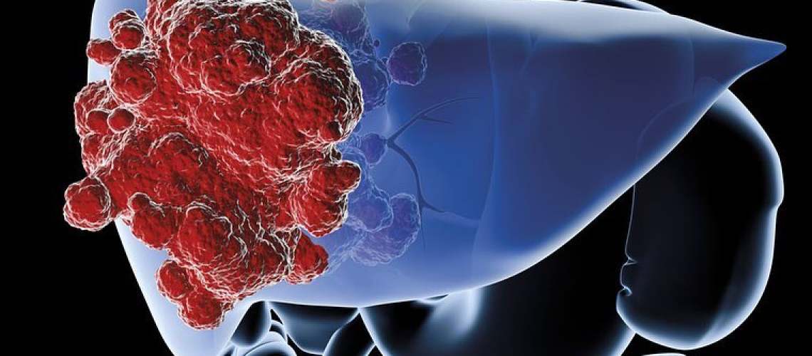 دکتر همانژیوم کبدی در اهواز